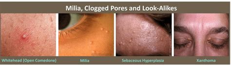 Milia Treatment Plano TX - Clogged Pores Treatment Frisco TX