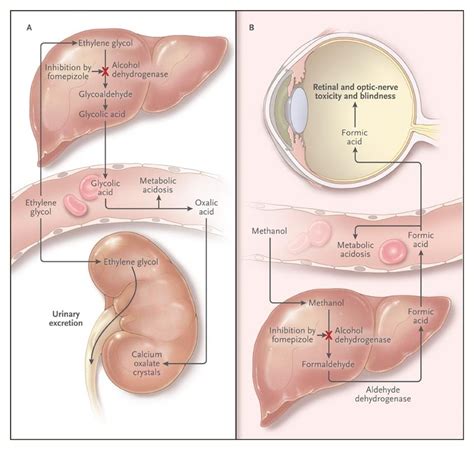 Fomepizole for Ethylene Glycol and Methanol Poisoning | NEJM