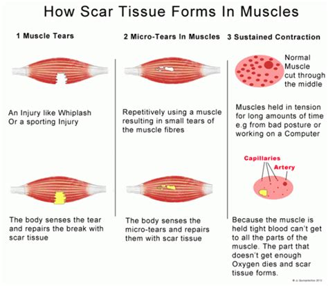 scar-tissue — Back to Health Wellness Centre