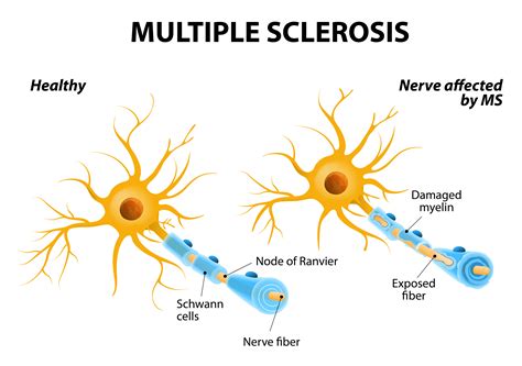 About Multiple Sclerosis :: ZyVersa Therapeutics, Inc.