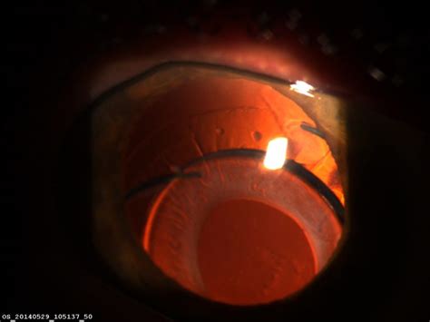 Postoperative complications - The Cataract Course