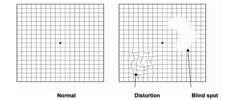 Macular Degeneration Eye Chart Grid