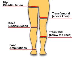 Lower Limb Amputations Categories | Capital Health | Orthotics and prosthetics, Physical ...