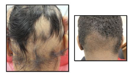 Comparing Ophiasis Alopecia Areata to Occipital Frontal Fibrosing ...