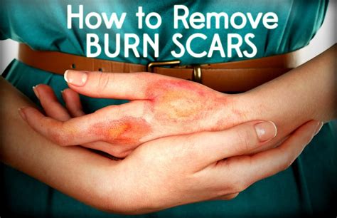 Burn Scars | Medscar