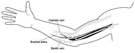 Transposition of the basilic vein for arteriovenous fistula: an endoscopic approach1 - Journal ...