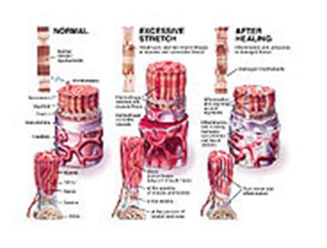 Medivisuals Soft Tissue Injury Medical Illustration