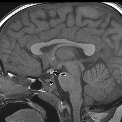 Ectopic neurohypophysis. Sagittal T1-weighted MR image of the sella... | Download Scientific Diagram