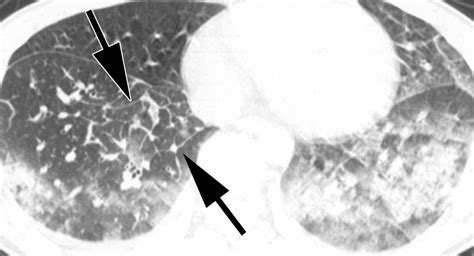 Acute eosinophilic pneumonia - The Clinical Advisor