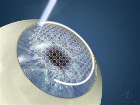 FemtoSecond Laser