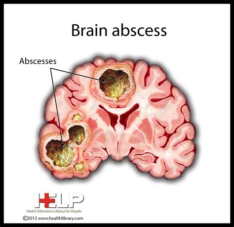 Brain Abscess | Nclex, Nurse practioner, Nclex study