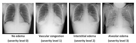 Quantification of Pulmonary Edema in Chest Radiographs | MIT CSAIL