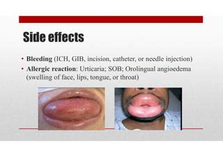 Acute ischemic stroke on alteplase therapy (thrombolysis) nursing ...