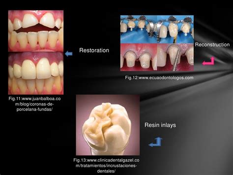 Composite resin