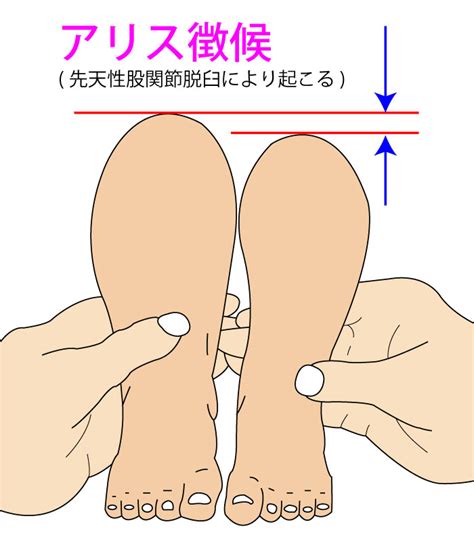 アリステスト(アリス徴候)【股関節の検査】