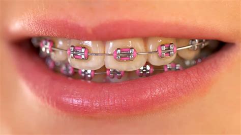 Pink Smiles to End Breast Cancer - Orthodontist Columbus Ohio