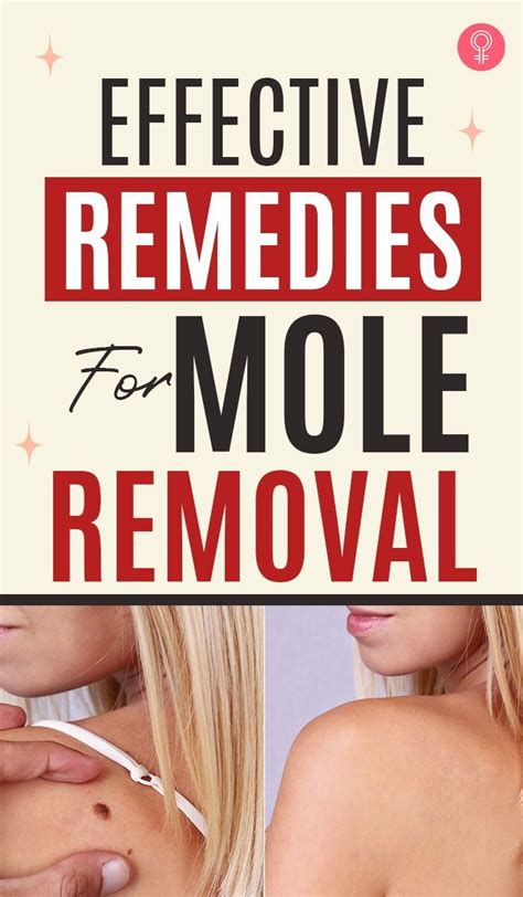 24 effective home remedies for mole removal – Artofit