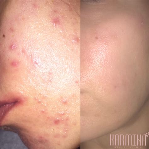 Microneedling & Glycolic Acid Peels For Acne Scars Treatment