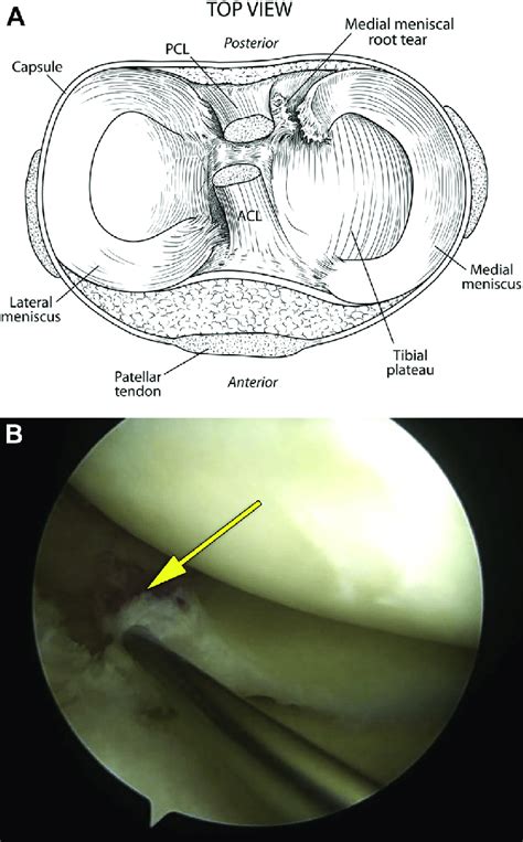 (A) Top view of the knee showing a medial meniscal posterior root tear ...