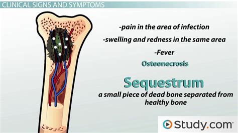 What is Osteomyelitis? - Definition, Symptoms & Treatment - Lesson | Study.com