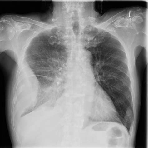 Calcinosis in CREST syndrome | Radiology Case | Radiopaedia.org | Crest syndrome, Crest, Radiology