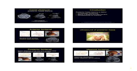 Anterior fontanel Ultrasound of posterior fossa...Meijler and Steggerda ...