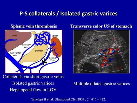 Doppler ultrasound of portal vein thrombosis