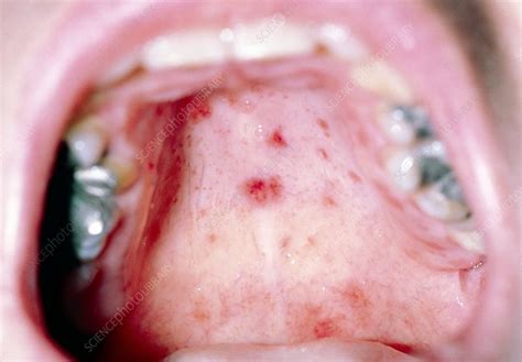 Hand, Foot & Mouth disease: blisters inside mouth - Stock Image - M170/0125 - Science Photo Library