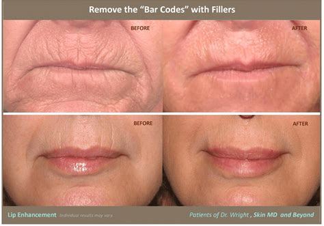 Restylane Treatment Plano, TX | Retylane Injections Frisco, TX