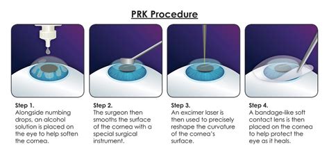 PRK Eye Surgery Costs & Procedure | Laser Eye Surgery Hub