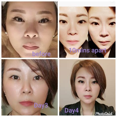 My Hiko Nose Thread Lift Review - Before / After Photos Included! - With Love,