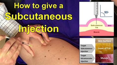 How to Give a Subcutaneous Injection Video - YouTube