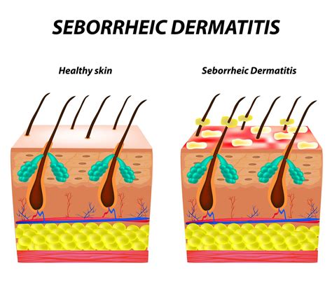 Seborrheic Dermatitis: Signs, Symptoms, and Complications