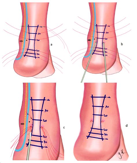 Percutaneous repair of the Achilles tendon. (a) The medial and lateral... | Download Scientific ...