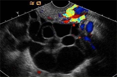 Theca Luteum Cyst