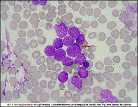 T-lymphoblastic leukaemia/lymphoma - CELL - Atlas of Haematological ...