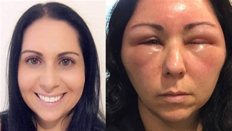 Woman's allergic reaction to hair dye causes severe swelling in face, head | FOX 29 Philadelphia