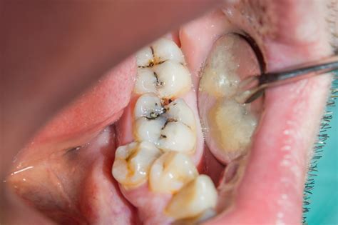 Redefining the Future of Health Services: Hyperdontia Causes Symptoms ...