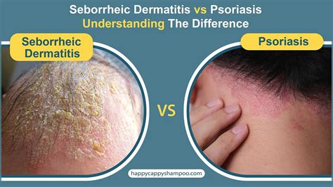 Seborrheic Dermatitis vs Psoriasis: Understanding The Difference