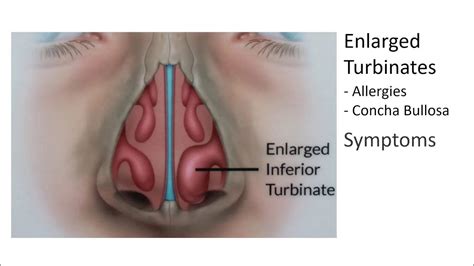 Enlarged Nasal Turbinates, Symptoms, and Treatment - YouTube