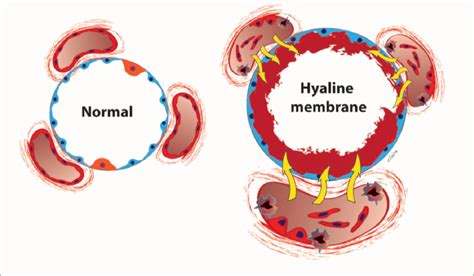 Hyaline membrane disease