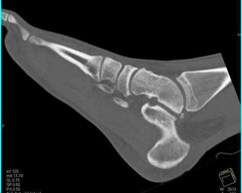 Comminuted Calcaneal Fracture - Musculoskeletal Case Studies - CTisus CT Scanning