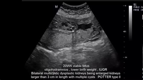 CASE 260 FETAL ULTRASOUND POTTER TYPE II MDK - YouTube