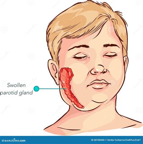 List 103+ Images Pictures Of Swollen Salivary Glands Sharp