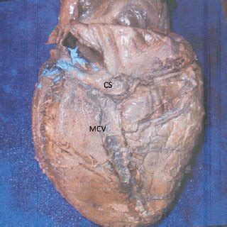 Origin of the great and middle cardiac veins | Download High-Resolution Scientific Diagram