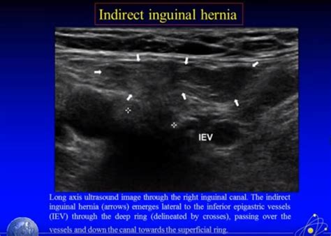 Ultrasound Imaging of Hernia Parts 1 + 2 of 4 - A YouTube Video - Tom ...