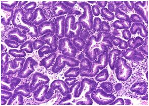 Endometrial hyperplasia Archives - Bangladesh Academy of Pathology