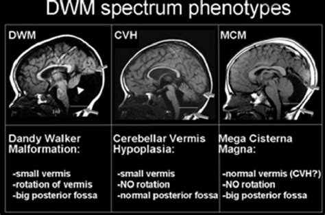 Apa Itu Dandy Walker Syndrome - Maren-has-Harmon