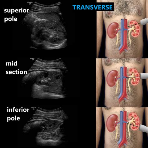 Kidney Ultrasound Labeled