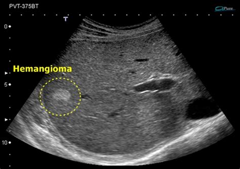 Liver - Sonography | Medicína, nemoci, studium na 1. LF UK